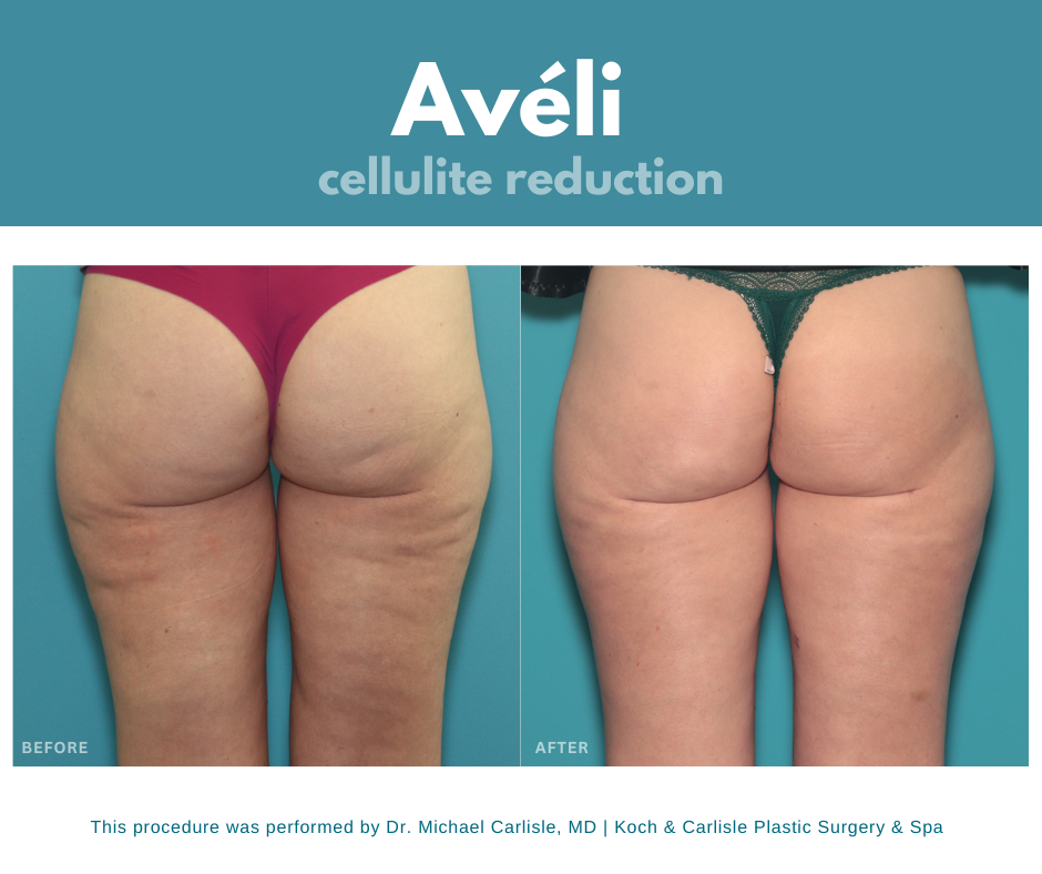 Aveli cellulite treatment for buttocks before and after photo 1