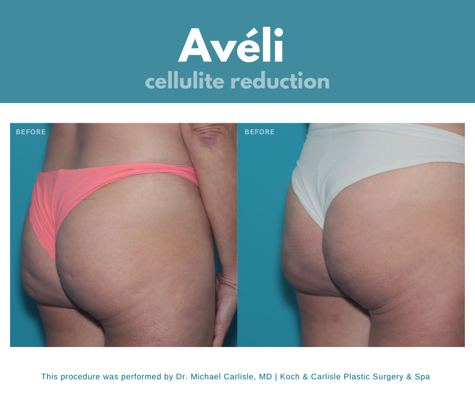 Aveli cellulite treatment for buttocks before and after photo 2