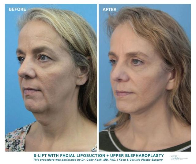 Check out this gorgeous result created by Dr. Cody Koch, MD, PhD of Koch & Carlisle Plastic Surgery in West Des Moines! 👏

Our patient underwent an S-Lift procedure with facial liposuction and an upper blepharoplasty. She is loving how everything turned out.

At your consultation at Koch & Carlisle Plastic Surgery, your surgeon will spend a great deal of time with you, discussing your goals, concerns, and physical and lifestyle considerations. 

He will listen intently to what you have to say, and together the two of you will develop the best approach to your treatment. Women and men who schedule their surgery at the time of consultation will have their consultation fee applied toward their procedure.

Curious about this procedure? We would be happy to get you started! Please give our office a call to schedule a comprehensive consultation with Dr. Cody Koch: 515-277-5555. 

More of Dr. Cody Koch's work can be viewed by visiting our online photo gallery: 
https://www.kochandcarlisle.com/photo-gallery/