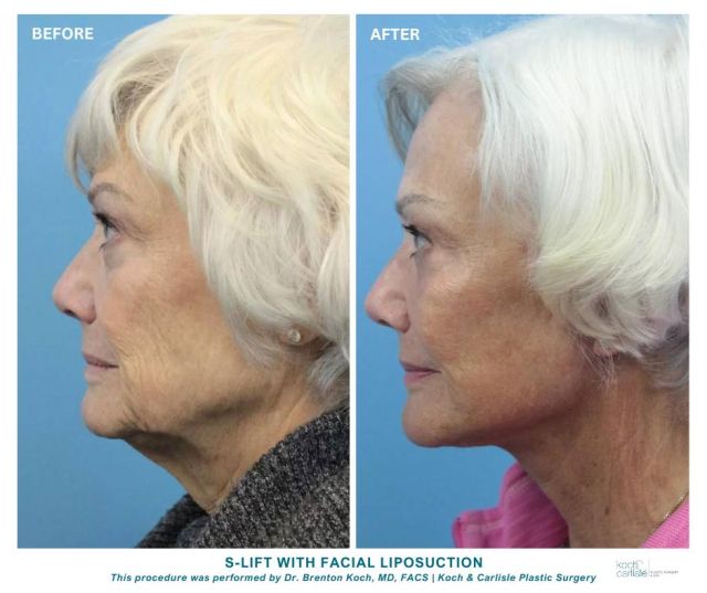 Another beautiful S-Lift result created by Dr. Brenton Koch, MD, FACS of Koch & Carlisle Plastic Surgery in West Des Moines, Iowa.

Dr. Koch's patient, 70, underwent an S-Lift with Facial Liposuction, and is loving her results! 

An S-Lift, or a mini facelift, is one of our most commonly performed procedures at Koch & Carlisle Plastic Surgery; it can be done in-office using local anesthesia, or under general anesthesia at our affiliated surgery center. 

This procedure rejuvenates the lower 1/3 of the face and the neck, and is less invasive than a deep plane facelift, making it best for people with mild to moderate aging of the face and neck. 

To learn more about this cosmetic procedure, schedule your consultation by calling Koch & Carlisle Plastic Surgery: 515-277-5555.

More information on the facelift procedure is available on our website: https://www.kochandcarlisle.com/plastic-surgery/facelift-neck-lift/