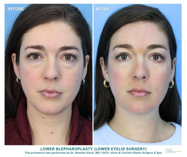 Following her lower blepharoplasty surgery with Dr. Brenton Koch, our patient is "very impressed" and "loves her results!" 🙌

The lower eyelid surgery can be performed using local anesthesia at our in-office operating suite, or under general anesthesia at our affiliated surgery center.

After eyelid surgery, our patients typically report that they can return to their normal activities within a few days of their procedure. Any slight bruising or swelling typically vanishes in 10 to 14 days. 

Most patients can resume exercising 3 to 4 weeks after their blepharoplasty procedure.

Call Koch & Carlisle Plastic Surgery to book your next consultation: 515-277-5555.