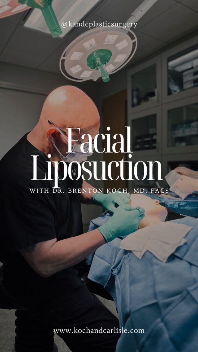 🎥: Take a look at the instant result of facial liposuction. This procedure was performed by Dr. Brenton Koch of Koch & Carlisle Plastic Surgery. 

It is a common misconception that only areas such as the hips, thighs, and abdomen can be contoured with liposuction. In West Des Moines, Iowa, facial plastic surgeons Dr. Brent Koch and Dr. Cody Koch perform liposuction to help patients remove excess fat from the jowls, neck, and chin for a dramatically improved appearance.

Our doctors can help you achieve improved facial contours by removing the fat from targeted areas of the face. 

As specialists in facial surgery, they have extensive training and more than 45 years of experience in performing facial procedures.

If you are interested in learning more about this procedure, we encourage you to book a consultation by calling Koch & Carlisle Plastic Surgery: 515-277-5555.

.
.
.
.
.
#drkochplasticsurgery #desmoinesplasticsurgeon #koch&carlisleplasticsurgery #westdesmoines #westdesmoinesiowa #facialliposuction #liposuction #liposuctionresults