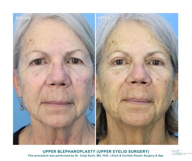 Following her upper blepharoplasty surgery with Dr. Cody Koch, our patient "loves her eyes."

..We're so happy to hear it! 👏

Our doctors restore a firmer, smoother appearance to the upper eyelids through upper blepharoplasty. 

The incision is placed within the upper lid crease, and extends slightly beyond the corner of the eye to remove the loose skin often present in this location. Underlying fat is removed to eliminate fullness.

Interested in learning more about this procedure? 
🎥 Watch Dr. Cody Koch perform an upper blepharoplasty: 
https://www.instagram.com/p/C51QmkRvKFy/?hl=en

📸 Check out our "before and after" photo gallery: https://www.kochandcarlisle.com/photo-gallery/

📞 Schedule your next consultation: 515-277-5555