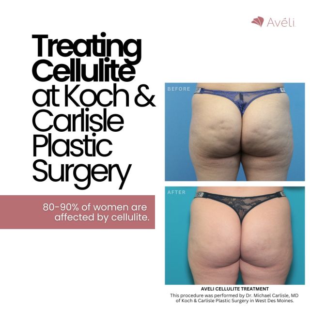 Yes, we can treat cellulite at Koch & Carlisle Plastic Surgery. ⚡

"Avéli is a cellulite treatment I’ve been performing since its very beginning, and we’ve seen some excellent results," according to Dr. Carlisle.

Did you know, 80-90% of women are affected by cellulite? 

"Cellulite is caused by fibrous bands of collagen that create a skin dimple on the surface by pulling down on the underside of the skin, making it a structural issue."

Dr. Carlisle uses #Avéli, a minimally invasive device to treat the dents, divots, and dimples associated with cellulite on the buttocks and thighs. This minimally invasive treatment can be done in our in-office operating suite, or under general anesthesia at our affiliated surgery center. 

To learn more about Avéli, simply scroll over to read more from Dr. Carlisle, or schedule an in-person consultation by calling Koch & Carlisle Plastic Surgery: 515-277-5555.

.
.
.
.
@drcarlisleplasticsurgery 
@kandcplasticsurgery 
@aveli 
#aveli #cellulitereduction #cellulitetreatment #westdesmoinesiowa #nationalcelluliteday #thenakedtruthaboutcellulite