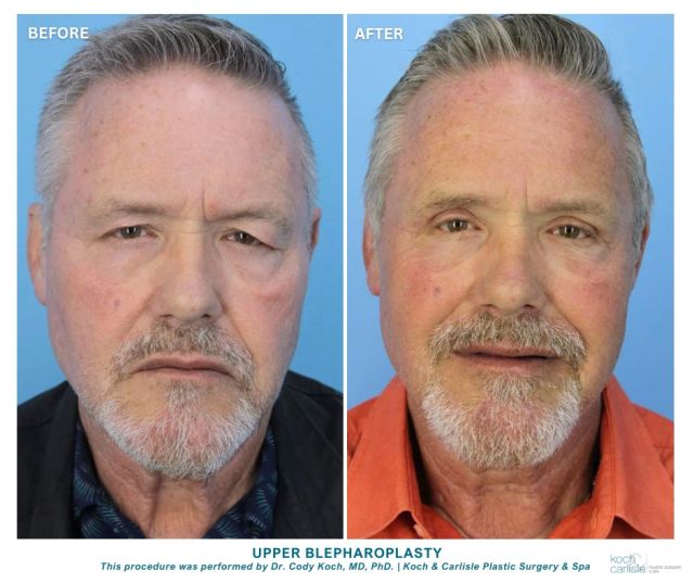 Check out the instant results from this upper blepharoplasty!

Awesome results by Dr. Cody Koch. 👏

The longevity of results varies with several factors, including age at the time of surgery, skin elasticity, and lifestyle. 

Upper eyelid surgery lasts at least 10 years and lower eyelid surgery lasts longer.

To learn more about this procedure, head on over to our website:
➡https://shorturl.at/T7zgw