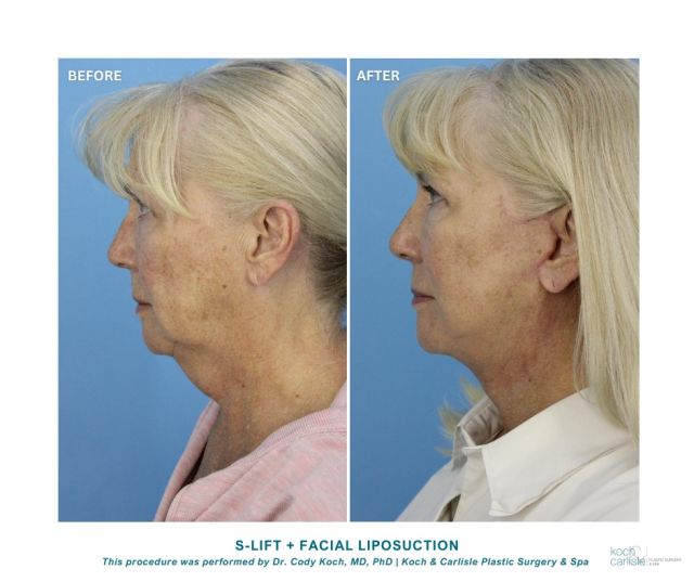 Dr. Cody Koch's patient is so happy with her results following her S-Lift and facial liposuction procedure.

At Koch & Carlisle Plastic Surgery, both Dr. Cody Koch and Dr. Brenton Koch exclusively perform facial plastic surgery. Our surgeons believe it is preferable to focus intensely on a single area of specialty. 

Therefore, our facial specialists perform far more facial procedures in a given period than other plastic surgeons, allowing patients to count on their thorough experience.

If you're interested in booking a consultation with one of our facial plastic surgeons, please call our office at 515-277-5555, or inquire online here:
➡ https://www.kochandcarlisle.com/contact-us/