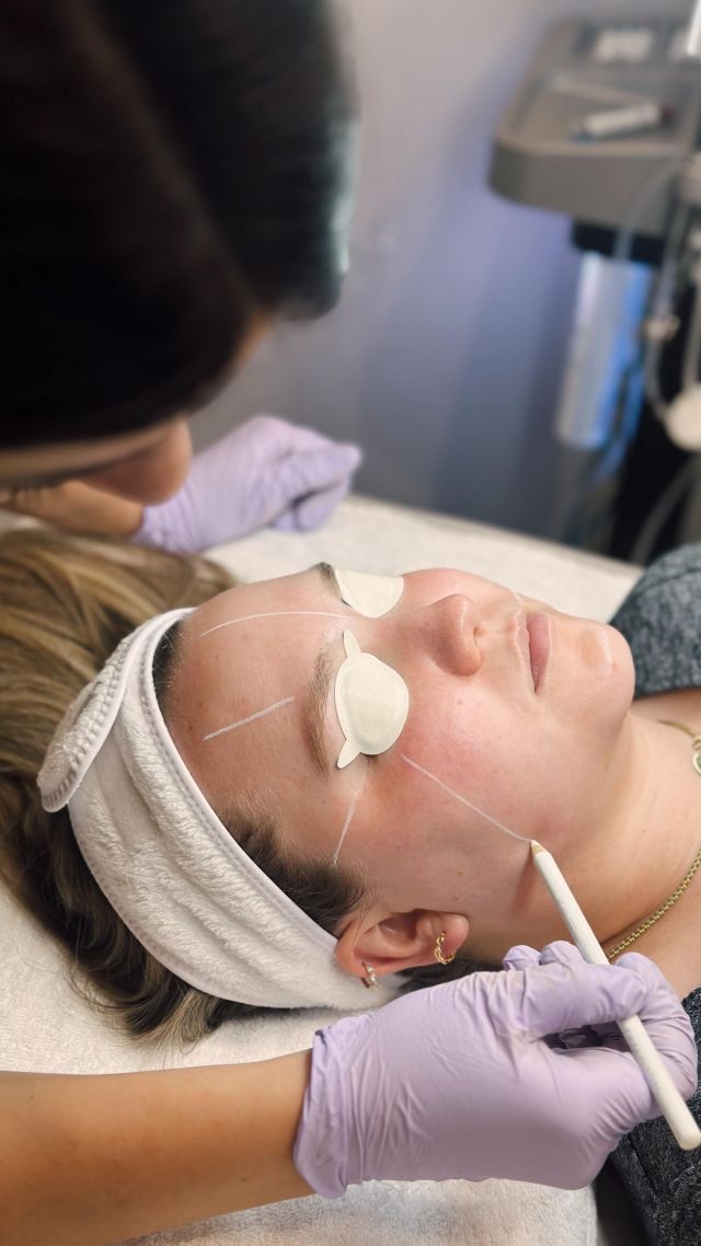 A glimpse inside a recent #clearsilk treatment at our medical spa. ⚡️

Our clinical aesthetician Karli uses white eyeliner to map her patient’s treatment prior to starting the ClearSilk. Per Karli, creating sections results in a more quick and efficient treatment. 🙌

ClearSilk by @sciton_inc is great for everyone, especially those looking to improve redness and aging skin.