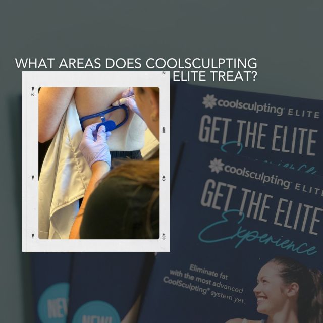 During your treatment, CoolSculpting Elite uses a controlled cooling process called cryolipolysis to kill fat cells that lie just beneath the skin, while leaving surrounding tissues unharmed. The body gradually flushes away the dead fat cells through its natural cleansing process, and treated areas become slimmer.

The CoolSculpting Elite procedure is effective for getting rid of fat on many common trouble spots. 

Interested in learning more? Check out our website, or schedule a complimentary CoolSculpting consultation at our office:
➡ 515-277-5555
➡ https://www.kochandcarlisle.com/med-spa/coolsculpting-elite/