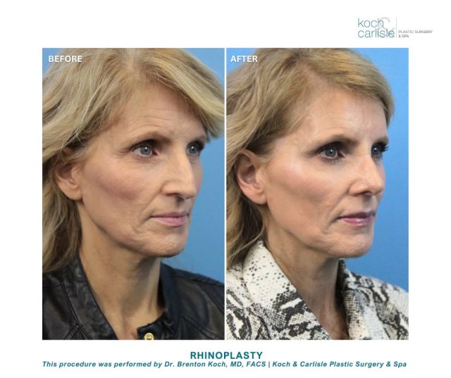 Rhinoplasty can redefine your nose’s appearance and bring it into harmony and balance with the other facial features. 

This rhinoplasty procedure was performed by Dr. Brenton Koch, MD, FACS of Koch & Carlisle Plastic Surgery. 

Through cosmetic rhinoplasty, the appearance of the nose can be altered by:
+ Reducing a nasal hump
+ Changing the shape of the tip or bridge
+ Raising or lowering the tip
+ Narrowing the span of the nostrils

If you are interested in learning more, we encourage you to call our office to request a consultation: 515-277-5555