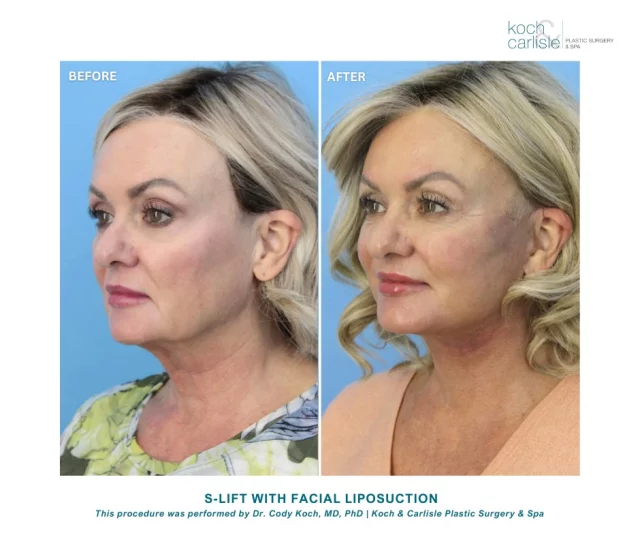 Another gorgeous S-Lift result crafted by Dr.  Cody Koch of Koch & Carlisle Plastic Surgery! 

At Koch & Carlisle Plastic Surgery & Spa, our facial plastic surgeons — Dr. Brenton Koch, MD, FACS, and Dr. Cody Koch, MD, PhD — exclusively perform facial plastic surgery. Our surgeons believe it is preferable to focus intensely on a single area of specialty.

Therefore, our facial specialists perform far more facial procedures in a given period than other plastic surgeons, allowing patients to count on their thorough experience. 

Check out more "before & after" photos on our photo gallery:
➡ https://www.kochandcarlisle.com/photo-gallery/