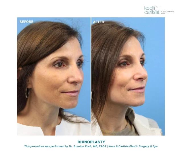 Cosmetic rhinoplasty creates a more proportional, harmonious nose while honoring your face’s unique aesthetic integrity.

[This rhinoplasty procedure was performed by Dr. Brenton Koch, MD, FACS of Koch & Carlisle Plastic Surgery & Spa.]

Through cosmetic rhinoplasty, the appearance of the nose can be altered by:
➡Reducing a nasal hump
➡Changing the shape of the tip or bridge
➡Raising or lowering the tip
➡Narrowing the span of the nostrils

Rhinoplasty results last indefinitely as long as the nose is not injured. While the aging process affects the nose, the improvements from surgery remain fairly consistent.

Interested in scheduling a consultation? Give our office a call to set up your in-person visit: 515-277-5555