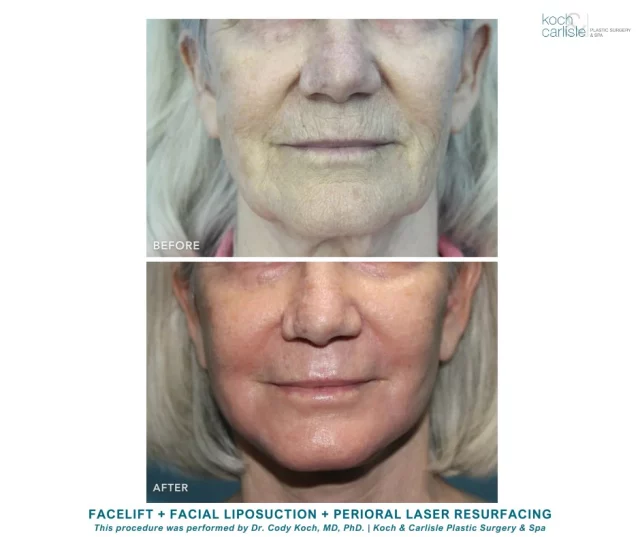 Check out this gorgeous result created by Dr. Cody Koch of Koch & Carlisle Plastic Surgery & Spa! ✨

Our patient received a facelift with facial liposuction and perioral laser resurfacing.

Laser resurfacing delves deep into the skin, effectively reducing even the most persistent imperfections, including scars, wrinkles, and uneven texture, to reveal a radiant, healthy complexion.

Interested in seeing more of Dr. Cody Koch's work? Check out our photo gallery located on our website:
➡ https://www.kochandcarlisle.com/photo-gallery/
.
.
.
.
.
.
@kandcplasticsurgery 
#laser #laserresurfacing #laserresults #kochandcarlisleplasticurgery #desmoines #desmoinesiowa #medicalspa #boardcertified #boardcerifiedplasticsurgeon #westdesmoines #wdm