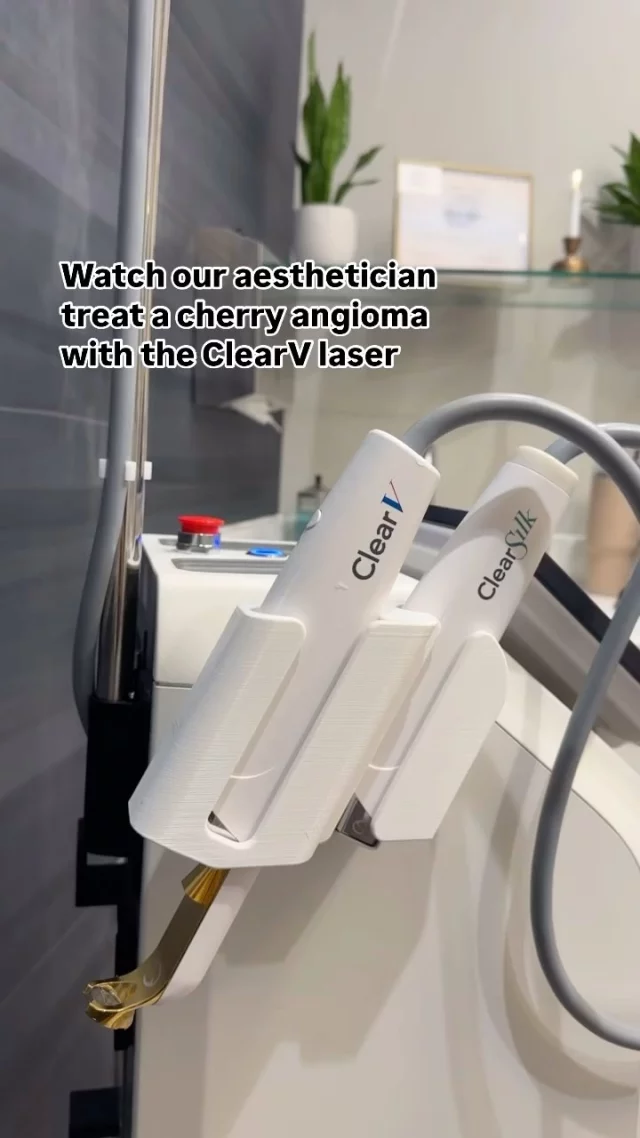 WATCH: Our aesthetician, Allison, treats an area with our ClearV laser! ⚡

ClearV eliminates target vessels without damaging the skin. This laser uses targeted heat to clear away skin concerns, including broken capillaries, spider veins, vascular lesions, skin discoloration, and more.

The ClearV laser has integrated cooling to minimize discomfort, so no numbing cream is needed.

Following your treatment, the skin will look and feel sunburned for 24 to 48 hours, with treated concerns fading gradually within about 4 to 6 weeks.

If you are interested in receiving a custom plan to treat unwanted skin concerns, we encourage you to schedule a complimentary skincare consultation at our medical spa: 515-277-5555.

Koch and Carlisle Plastic Surgery & Spa is located at 4855 Mills Civic Parkway in West Des Moines, Iowa.

#westdesmoines #kochandcarlisleplasticsurgery #westdesmoinesiowa #clearv #laser #lasertreatment #laserskincare #laserskinrejuvenation