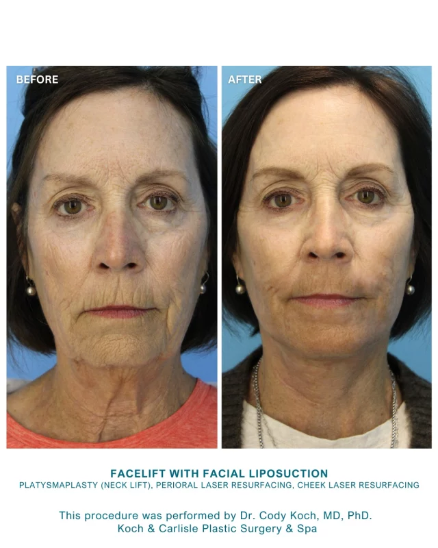 From the patient: "So glad I did it." 

Swipe over to see our patient's full transformation following her procedure with Dr. Cody Koch! 👏

Dr. Cody Koch performed an S-Lift with facial liposuction, a platysmaplasty (neck lift), along with perioral laser resurfacing and cheek laser resurfacing. 

With more than 45 years of combined experience, our facial plastic surgeons in West Des Moines have performed more facelift surgeries than any provider in the state. 

Dr. Brenton Koch and Dr. Cody Koch consistently deliver superior patient care and excellent results and are considered among the best facial plastic surgeons in Iowa.

Schedule a one-on-one consultation with our board-certified plastic surgeons by calling Koch & Carlisle Plastic Surgery & Spa: 
➡ 515-277-5555

Koch & Carlisle Plastic Surgery & Spa is located at 4855 Mills Civic Parkway in West Des Moines, Iowa.

.
.
.
.
.
#facelift #faceliftsurgery #boardcertified #boardcertifiedplasticsurgeon #kochandcarlisleplasticurgery #iowamedicalspa #westdesmoines