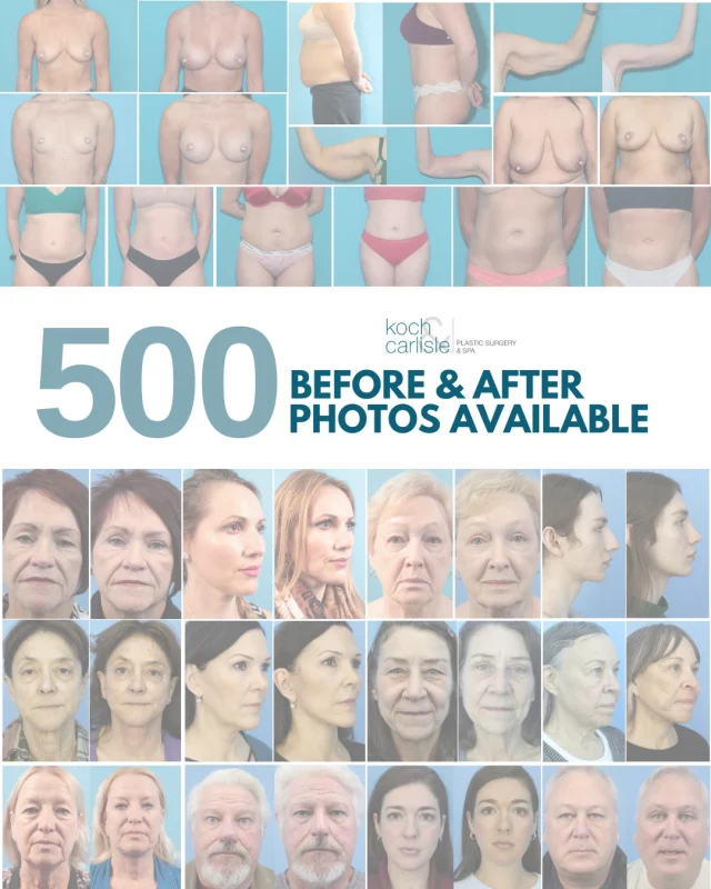 This week we uploaded our 500th "Before & After" case, and it would not be possible without our wonderful patients! 👏

Thank you to our amazing patients for sharing your journey! We are honored to be part of your story and appreciate your trust in Koch & Carlisle Plastic Surgery & Spa. 

To see the work done by our board-certified doctors, check out our online photo gallery on our website:
➡ https://www.kochandcarlisle.com/photo-gallery/