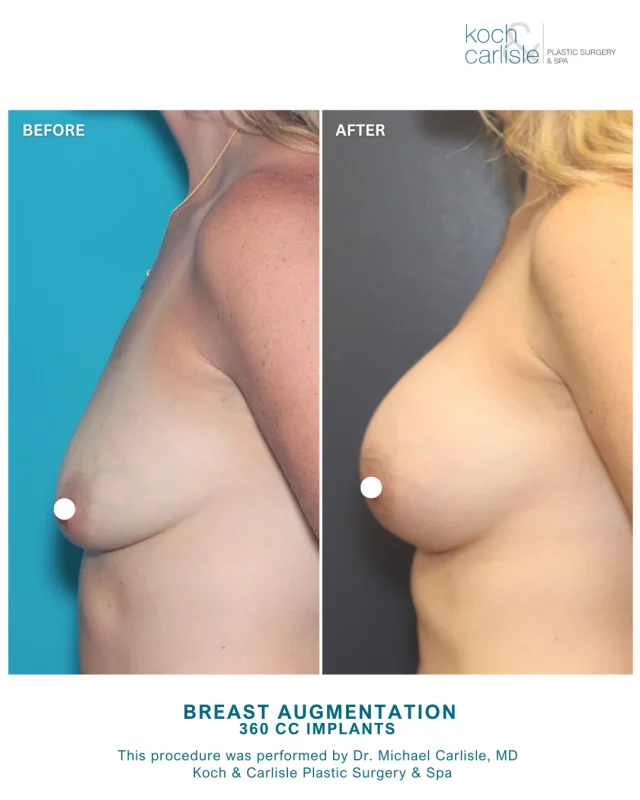 From the Patient: "LOVE, LOVE, LOVE. Best decision!"

Our patient is a mother of 4 who experienced deflation following breast feeding. She received 360 cc implants and is pictured 3 months post-op in her "after" photos.

This procedure was performed by Dr. Michael Carlisle, MD of Koch & Carlisle Plastic Surgery & Spa. Dr. Carlisle is a board-certified plastic surgeon who specializes in breast and body procedures at Koch & Carlisle Plastic Surgery & Spa in West Des Moines. 

As a breast and body specialist, Dr. Carlisle works exclusively with patients interested in:
➖Breast Augmentation
➖Breast Lift (Mastopexy)
➖Breast Implant Removal & Capsulectomy
➖Nipple & Areola Reduction
➖Tummy Tuck (Abdominoplasty)
➖Surgery After Weight Loss (Arm Lift, Thigh Lift, Gluteal/Back Lift)
➖Brazilian Butt Lift
➖Labiaplasty
➖Liposuction
➖Gynecomastia Surgery
➖Monsplasty
➖Mastectomy

To see more of Dr. Carlisle's work, head on over to our online photo gallery:
➡ https://www.kochandcarlisle.com/photo-gallery/

Consultations with Dr. Carlisle can be made by calling Koch & Carlisle Plastic Surgery: 515-277-5555