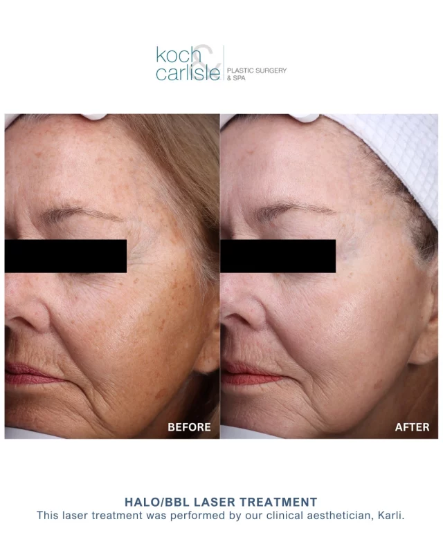 Check out our patient's gorgeous results following a HALO/BBL laser treatment! 👏🙌
This medical spa treatment was performed by our clinical aesthetician, Karli.

Laser skin resurfacing with the Sciton Halo hybrid fractional laser system can do what skincare products cannot – address deeper damage for a noticeable improvement in the texture, tone, and quality of your skin.

Halo technology uses two different wavelengths to simultaneously smooth and tighten skin, reduce fine lines, deeper wrinkles, enlarged pores, scarring, and stimulates collagen production. 

If you are interested in learning more, our clinical aestheticians would love to meet with you! Schedule your complimentary, in-person skincare consultation by calling Koch & Carlisle Plastic Surgery & Spa: 515-277-5555 | press "2" for our medical spa.