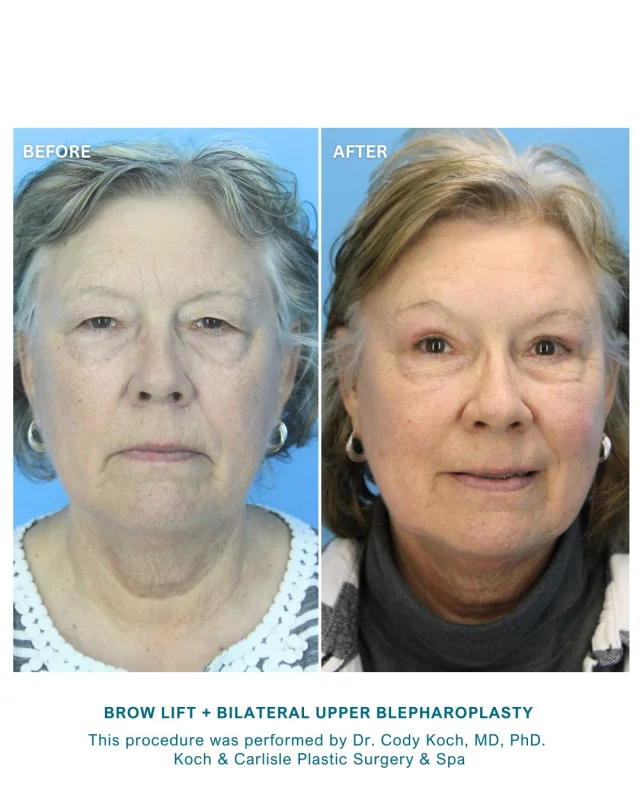 Swipe to see the full transformation of Dr. Cody Koch's patient following her brow lift and bilateral upper blepharoplasty procedure. Gorgeous! ❤

A brow lift is a proven procedure that safely and effectively:
➡Elevates drooping brows
➡Smoothes horizontal lines and furrows of the forehead
➡Restores a calm, youthful appearance to the upper face

Although most patients undergoing brow lifts are between the ages of 40 and 60, the procedure can be performed at any age if the person is in good health. 

During your in-person consultation, our doctor will determine if you are a good candidate for a brow lift. Both Dr. Brent Koch and Dr. Cody Koch perform this procedure at Koch & Carlisle Plastic Surgery & Spa.

Meet with our doctors by scheduling an in-person consultation: 515-277-5555
➖Inquire online: https://www.kochandcarlisle.com/contact-us/
.
.
.
.
.
@kandcplasticsurgery 
#kochandcarlisleplasticsurgery #kochandcarlisle #boardcertified #boardcertifiedplasticsurgeon #wdm #westdesmoines #upperblepharoplasty #browlift #browliftsurgery #desmoinesiowa #desmoines