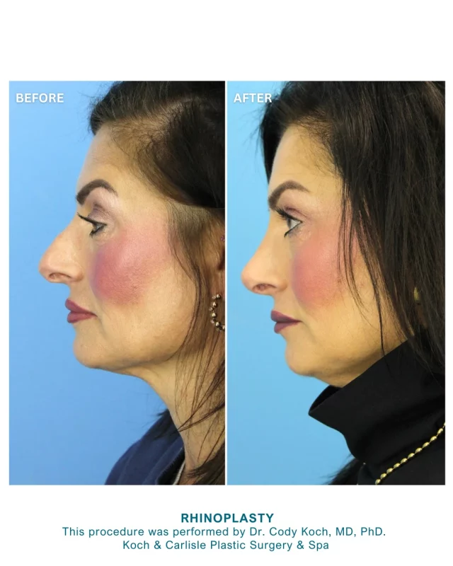 From the Patient: "Love the results! My nose looks so natural that you would never know I had a procedure. Wonderful office of professionals to work with and trust."

Dr. Cody Koch's patient is so happy following her rhinoplasty--we love to hear it! 🙌

A rhinoplasty can redefine your nose’s appearance and bring it into harmony and balance with the other facial features. 

As some of the top facial plastic surgeons in Iowa, our surgeons perform about 45 to 50 rhinoplasty procedures per year for our patients; they have performed more rhinoplasty procedures than any other practice in the state.

Interested in meeting with one of our board-certified plastic surgeons? Please call our office to schedule an in-person consultation: 515-277-5555

Check out our website to see more from our "Before & After" photo gallery:
➡https://www.kochandcarlisle.com/photo-gallery/