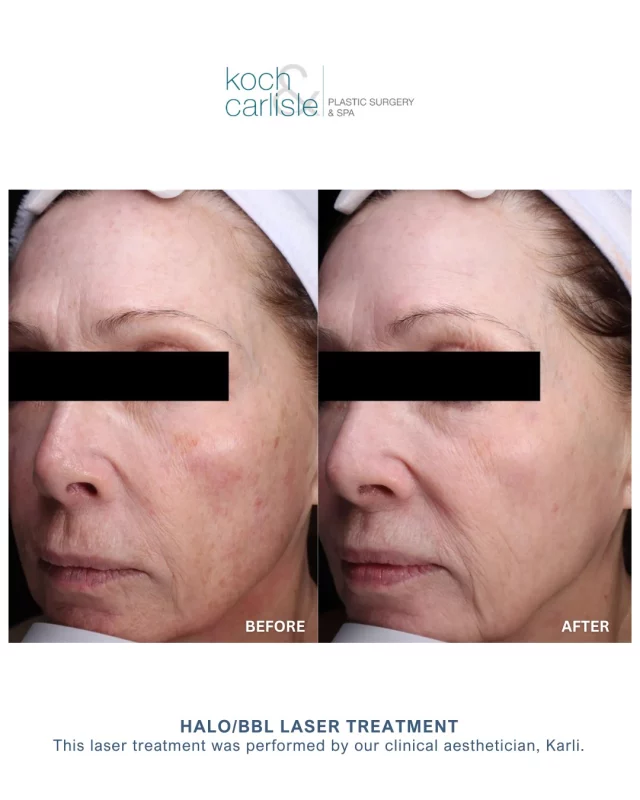 Swipe over to see the full results following a Halo/BBL treatment!⚡️

Let's talk #downtime following a Halo treatment:
Day 1: Mild/moderate redness and heat up to 2 hours post treatment
+ Mild swelling expected
+ Pinpoint red dots possible
+ Sandpaper-like texture
+ Pigment appears darker

Day 2: Experience less redness
+ Occasional prickly and dry
+ Puffy/swelling could increase
+ Browns and reds accelerate

Day 3: Peak of swelling
+ Dry texture
+ Skin sloughing begins

Day 4: New skin is sensitive
+ Sloughing continues
+ Blotchy skin
+ Slightly swollen

Day 5: Improved tone and texture
+ Smoother skin
+ Pigment continues to lighten for 5-10 days

Interested in learning more about our laser skincare treatments? Call today to schedule a complimentary skincare consultation with one our clinical aestheticians: 515-277-5555