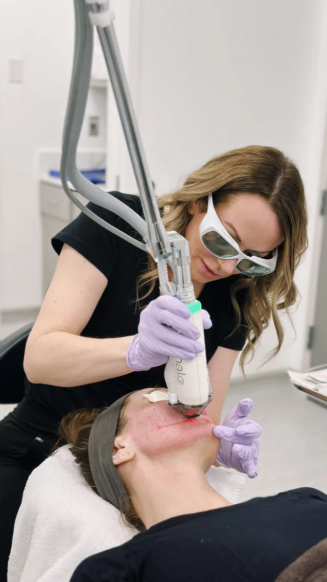 A popular laser combination at our office is the HALO/BBL, but what about the HALO/MOXI?

Our clinical aesthetician, Emily, recently completed a HALO/MOXI combination treatment on her patient and shares her take on who this treatment is ideal for. 

Following treatment with Halo, recuperation is much shorter than that of a traditional ablative laser. We advise patients to avoid sun exposure for the first week after treatment, but patients can often resume their normal daily activities, including the application of makeup, in just a day, depending on the level of treatment.

As the skin heals, new, softer skin develops, and collagen production ramps up. The results of your Sciton Halo treatment are long-lasting and beautiful.

Interested in learning more about our laser skincare treatments? We offer complimentary skincare consultations at our spa! 

To schedule, please call Koch & Carlisle Plastic Surgery & Spa: 515-277-5555 | press “2” for our medical spa.

#westdesmoines #kochandcarlisleplasticsurgery #medicalspa #laserskincare #laserskinresurfacing #moxi 

Koch & Carlisle Plastic Surgery & Spa is located at 4855 Mills Civic Parkway in West Des Moines, Iowa.